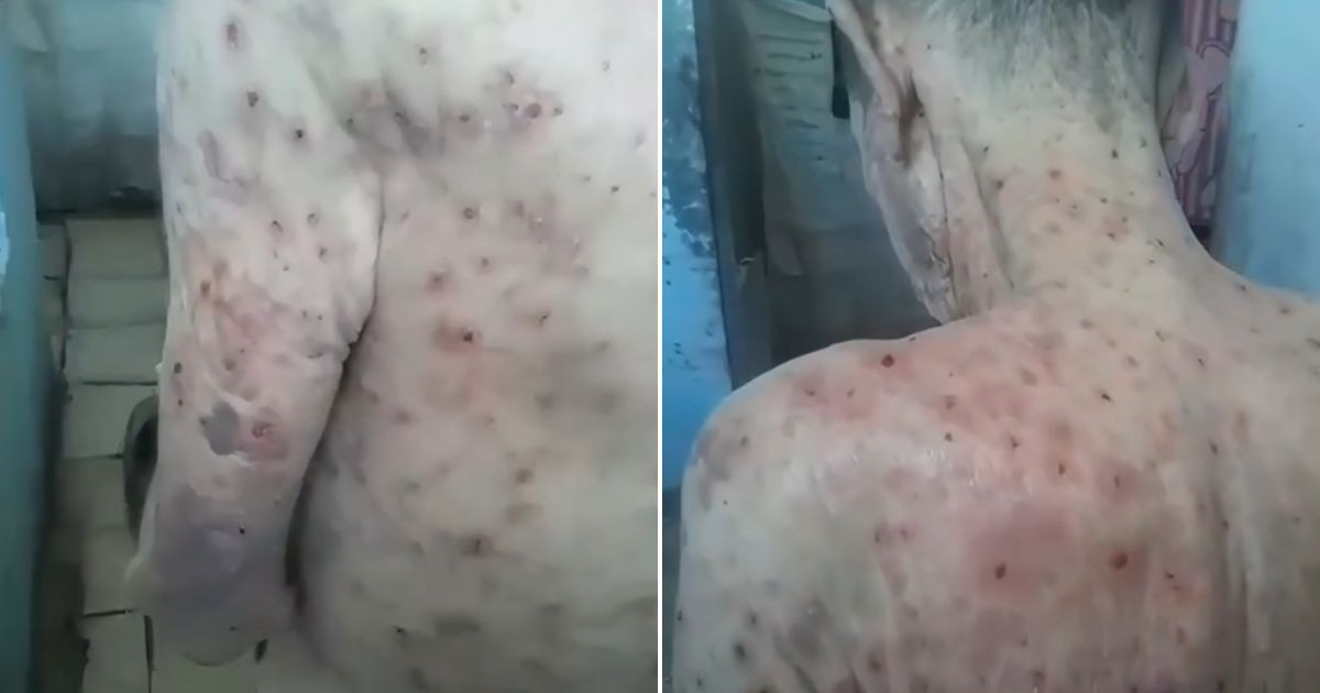 Graphic Video Exposes Dire Conditions in Holguín Prison: Inmate Plagued by Bedbugs