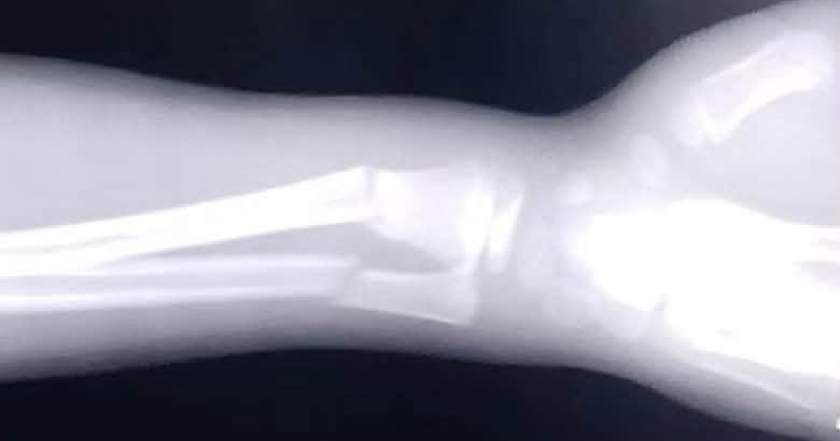 Child in Matanzas Hospital Denied Treatment Due to Lack of Plaster