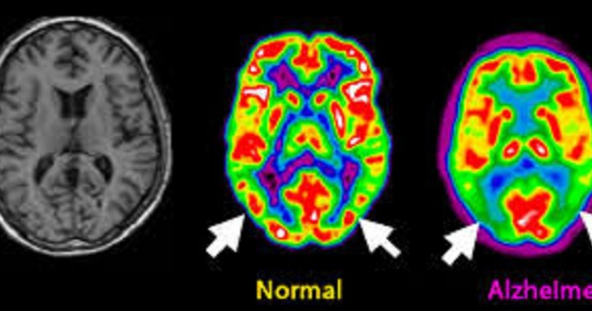 alzheimer, cerebro, resonancia magnética, placas, proteína beta-amiloide © Imagen: Alzheimer.peru.org