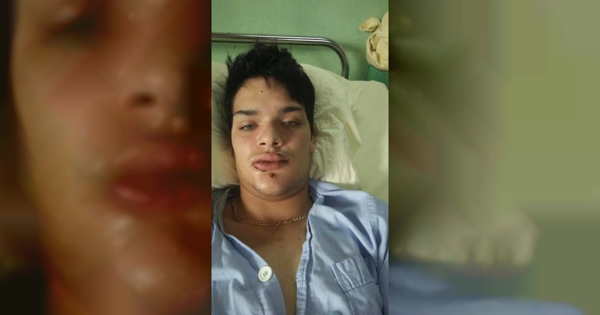 El joven cubano José Enrique Besada con fracturas en la cara © Facebook / José Enrique Besada