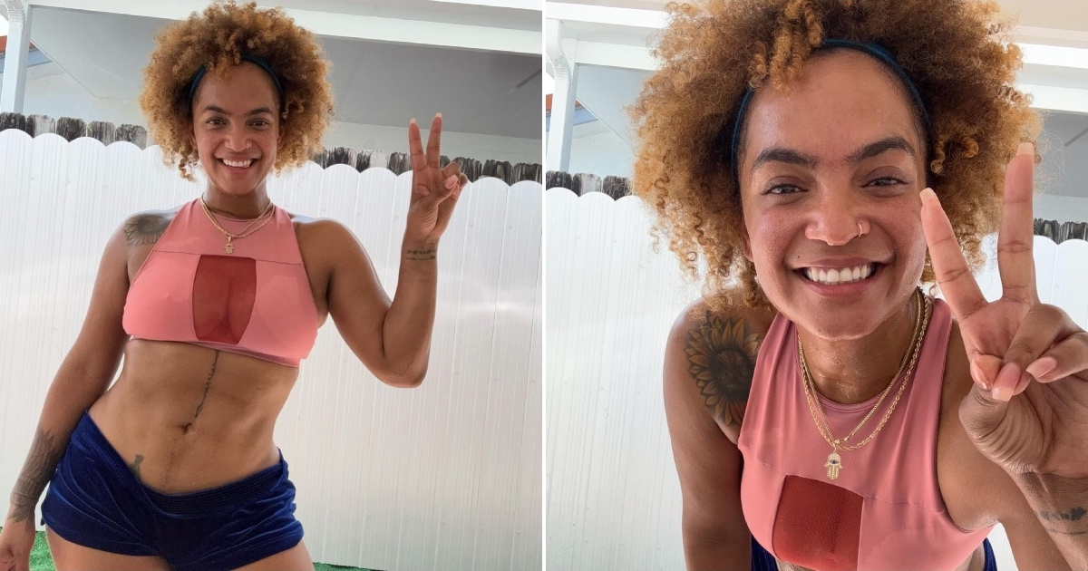 Seidy La Niña muestra con orgullo la cicatriz de su cirugía tras un accidente